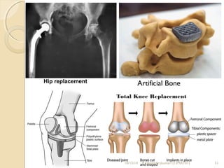 Hip replacement Artificial Bone 
Total Knee Replacement 
10/15/14 R.Devendirakumari (13MAT01) 51 
 