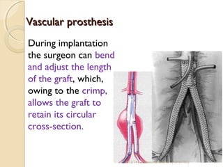 VVaassccuullaarr pprroosstthheessiiss 
During implantation 
the surgeon can bend 
and adjust the length 
of the graft, which, 
owing to the crimp, 
allows the graft to 
retain its circular 
cross-section. 
10/15/14 R.Devendirakumari (13MAT01) 54 
 
