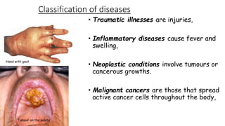 Classification of diseases
• Traumatic illnesses are injuries,
• Inflammatory diseases cause fever and
swelling,
Hand with gout

• Neoplastic conditions involve tumours or
cancerous growths.
• Malignant cancers are those that spread
active cancer cells throughout the body,

Tumour on the palate

 