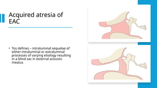 common disease of external ear.ppt orlhns | PPTX
