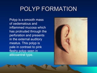 Disease of middle ear | PPT