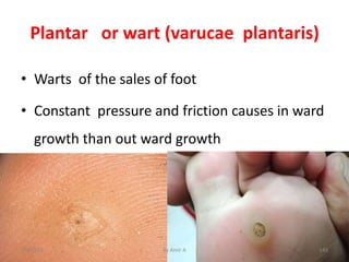 • Warts of the sales of foot
• Constant pressure and friction causes in ward
growth than out ward growth
Plantar or wart (...