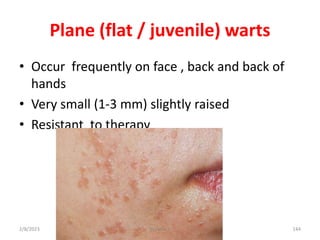 • Occur frequently on face , back and back of
hands
• Very small (1-3 mm) slightly raised
• Resistant to therapy
Plane (fl...