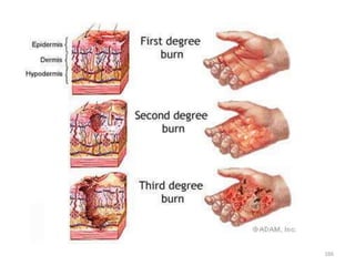 Extent of Body Surface Area Injured
• Various methods are used to estimate the
TBSA affected by burns
• among them are the...