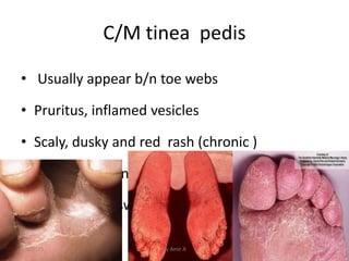 • Usually appear b/n toe webs
• Pruritus, inflamed vesicles
• Scaly, dusky and red rash (chronic )
• Lymphanitis and cellu...