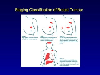 Staging Classification of Breast Tumour
 