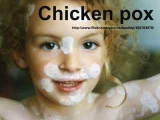 Chicken pox
   http://www.flickr.com/photos/auntiep/360764978/
 
