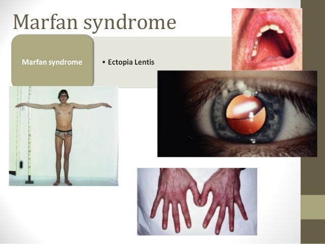 Ophthalmological manifestations of systemic diseases