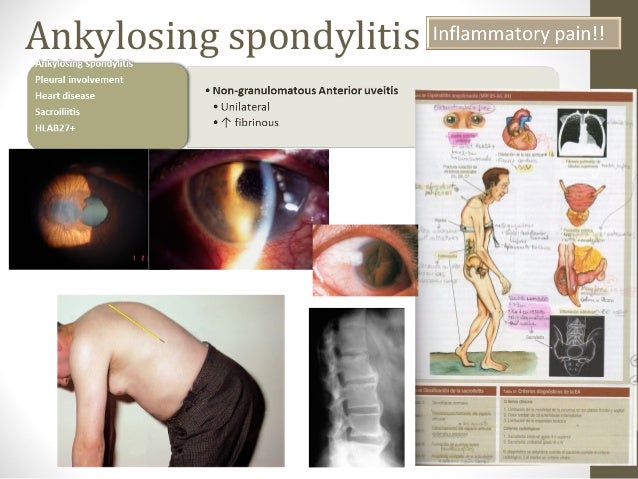 global ankylosing spondylitis market global ankylosing spondylitis market