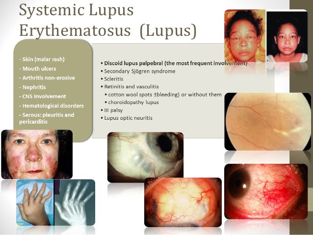 Ophthalmological manifestations of systemic diseases