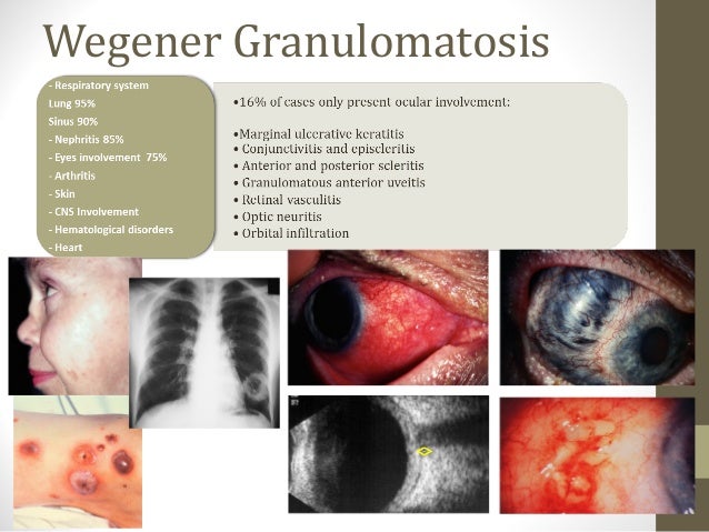 Ophthalmological manifestations of systemic diseases