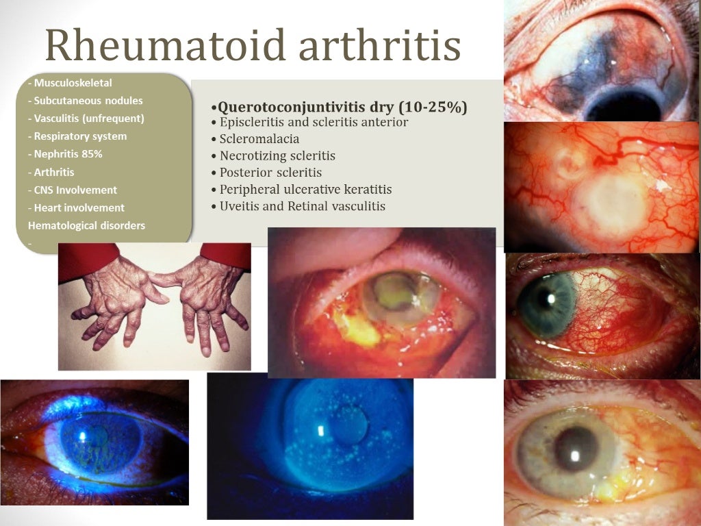 Ophthalmological manifestations of systemic diseases