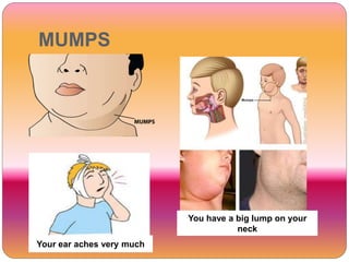 MUMPS
Your ear aches very much
You have a big lump on your
neck