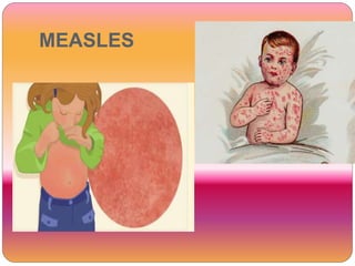 MEASLES