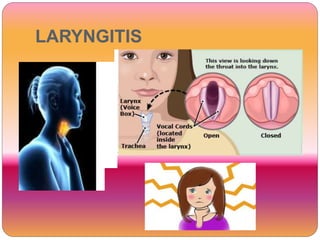 LARYNGITIS