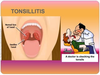 TONSILLITIS
A doctor is ckecking the
tonsils