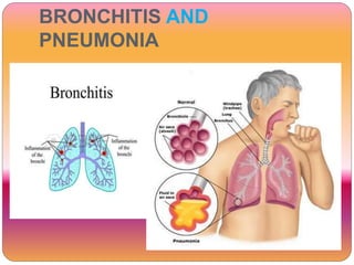 BRONCHITIS AND
PNEUMONIA