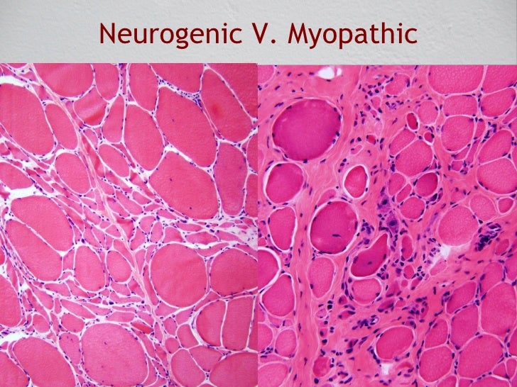Pathology Of Skeletal Muscle - 