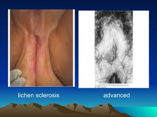 lichen sclerosis advanced
 
