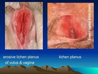 erosive lichen planus lichen planus
of vulva & vagina
 