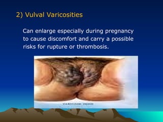 2) Vulval Varicosities
Can enlarge especially during pregnancy
to cause discomfort and carry a possible
risks for rupture or thrombosis.
 