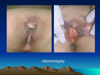 clitoromegaly
 