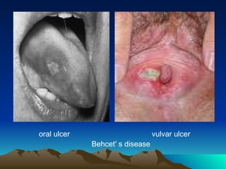 oral ulcer vulvar ulcer
Behcet′ s disease
 