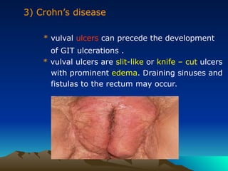 3) Crohn’s disease
* vulval ulcers can precede the development
of GIT ulcerations .
* vulval ulcers are slit-like or knife – cut ulcers
with prominent edema. Draining sinuses and
fistulas to the rectum may occur.
 