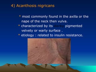 4) Acanthosis nigricans
* most commonly found in the axilla or the
nape of the neck then vulva.
* characterized by its darky pigmented
velvety or warty surface .
* etiology : related to insulin resistance.
 