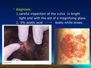 * diagnosis:
1.careful inspection of the vulva in bright
light and with the aid of a magnifying glass.
2. 5% acetic acid aceto white areas.
 