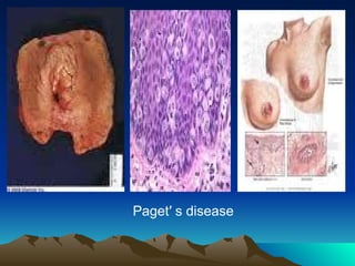 Paget′ s disease
 