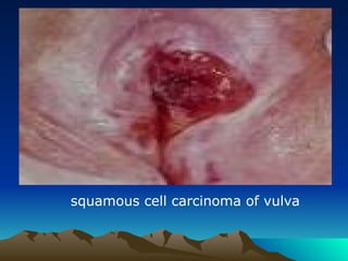 squamous cell carcinoma of vulva
 