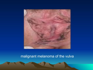 malignant melanoma of the vulva
 