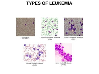 Leukemia Types Overview Comprehensive Overview of Blood Disorders: Anemia, WBC Disorders ...