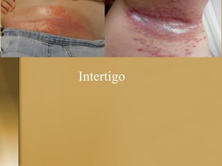 Diseases caused by yeast.pdf