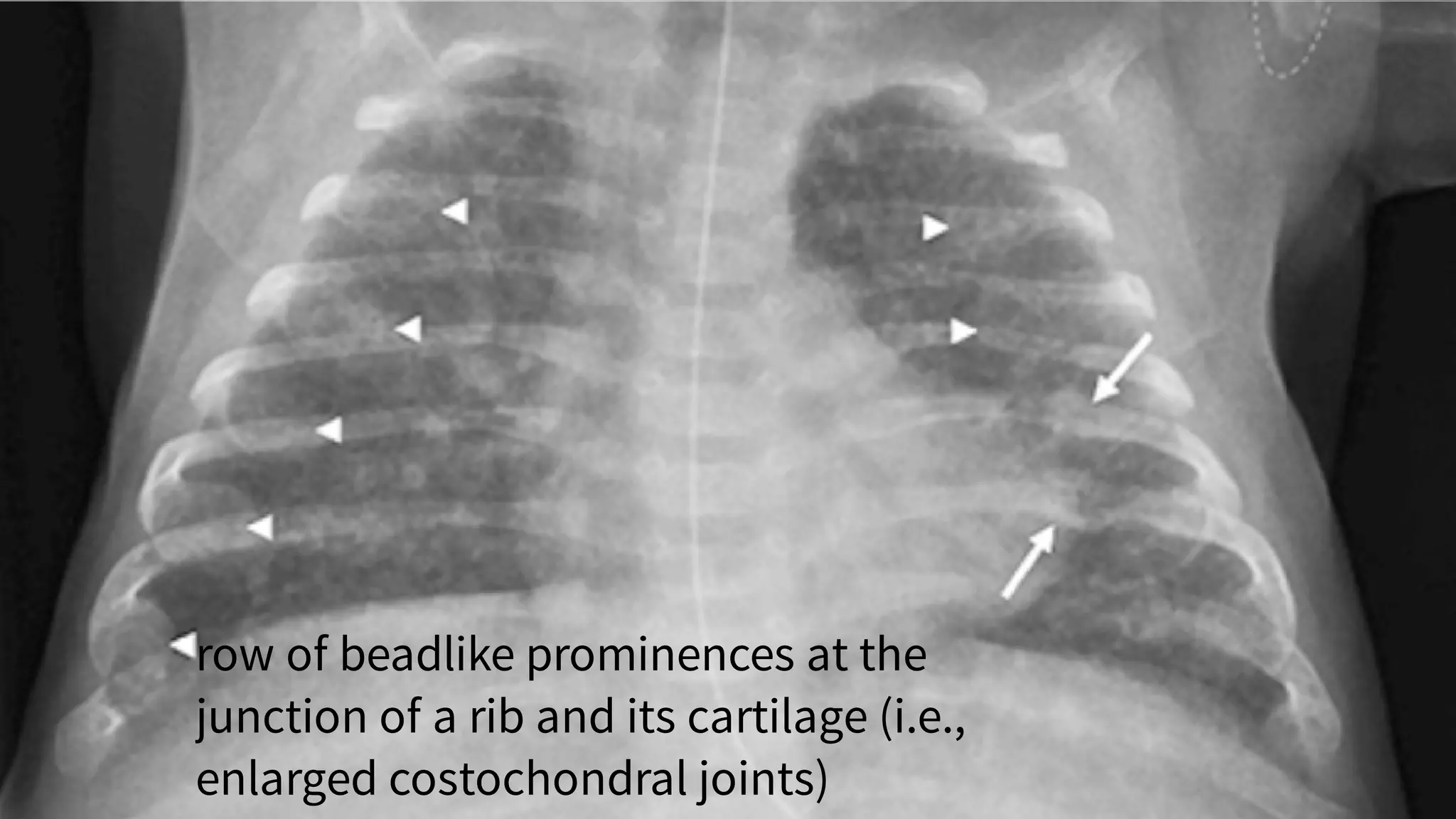 Diseases due to nutritional deficiency (1).pdf