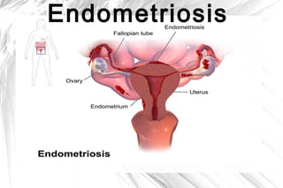 Endometriosis

 