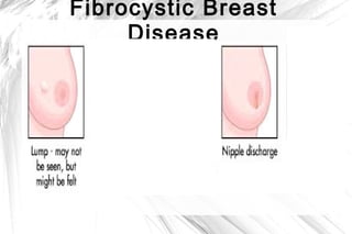 Fibrocystic Breast
Disease

 
