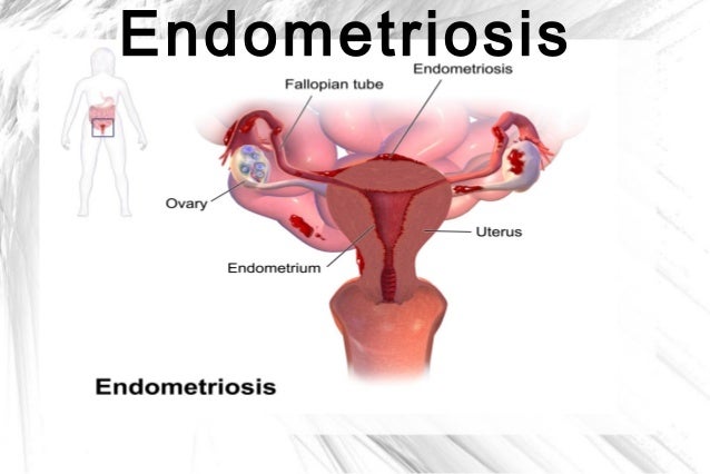 diseases female reproductive system reproductive system diseases