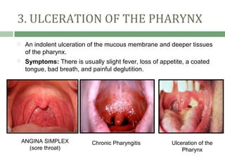 3. ULCERATION OF THE PHARYNX
    An indolent ulceration of the mucous membrane and deeper tissues
     of the pharynx.
    Symptoms: There is usually slight fever, loss of appetite, a coated
     tongue, bad breath, and painful deglutition.




    ANGINA SIMPLEX           Chronic Pharyngitis          Ulceration of the
      (sore throat)                                           Pharynx
 