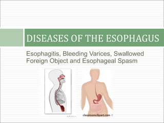 DISEASES OF THE ESOPHAGUS
Esophagitis, Bleeding Varices, Swallowed
Foreign Object and Esophageal Spasm
 