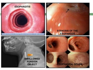ESOPHAGITIS




                  STENOSIS OF THE
                    ESOPHAGUS




      SWALLOWED
       FOREIGN
        OBJECT    ESOPHAGEAL SPASM
 