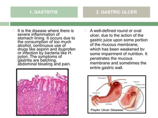 1. GASTRITIS                        2. GASTRIC ULCER



   It is the disease where there is      A well-defined round or oval
    severe inflammation of                 ulcer, due to the action of the
    stomach lining. It occurs due to       gastric juice upon some portion
    the consumption of too much
    alcohol, continuous use of             of the mucous membrane,
    drugs like aspirin and ibuprofen       which has been weakened bv
    or infection by bacteria like H.       some impairment of nutrition. It
    pylori. The symptoms of                penetrates the mucous
    gastritis are belching,
    abdominal bloating and pain.           membrane and sometimes the
                                           entire gastric wall.
 