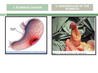 4. HEMORRHAGE OF THE
3. STOMACH CANCER
                          STOMACH
 