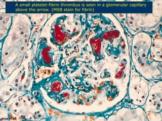 Diseases involving blood vessels of the kidney | PPT