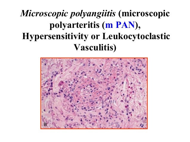 Diseases of blood vessels Diseases of blood vessels