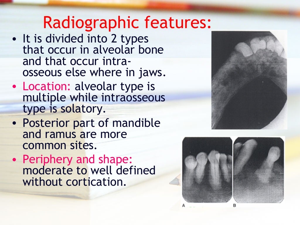 Diseases of bone manifested in the jaws