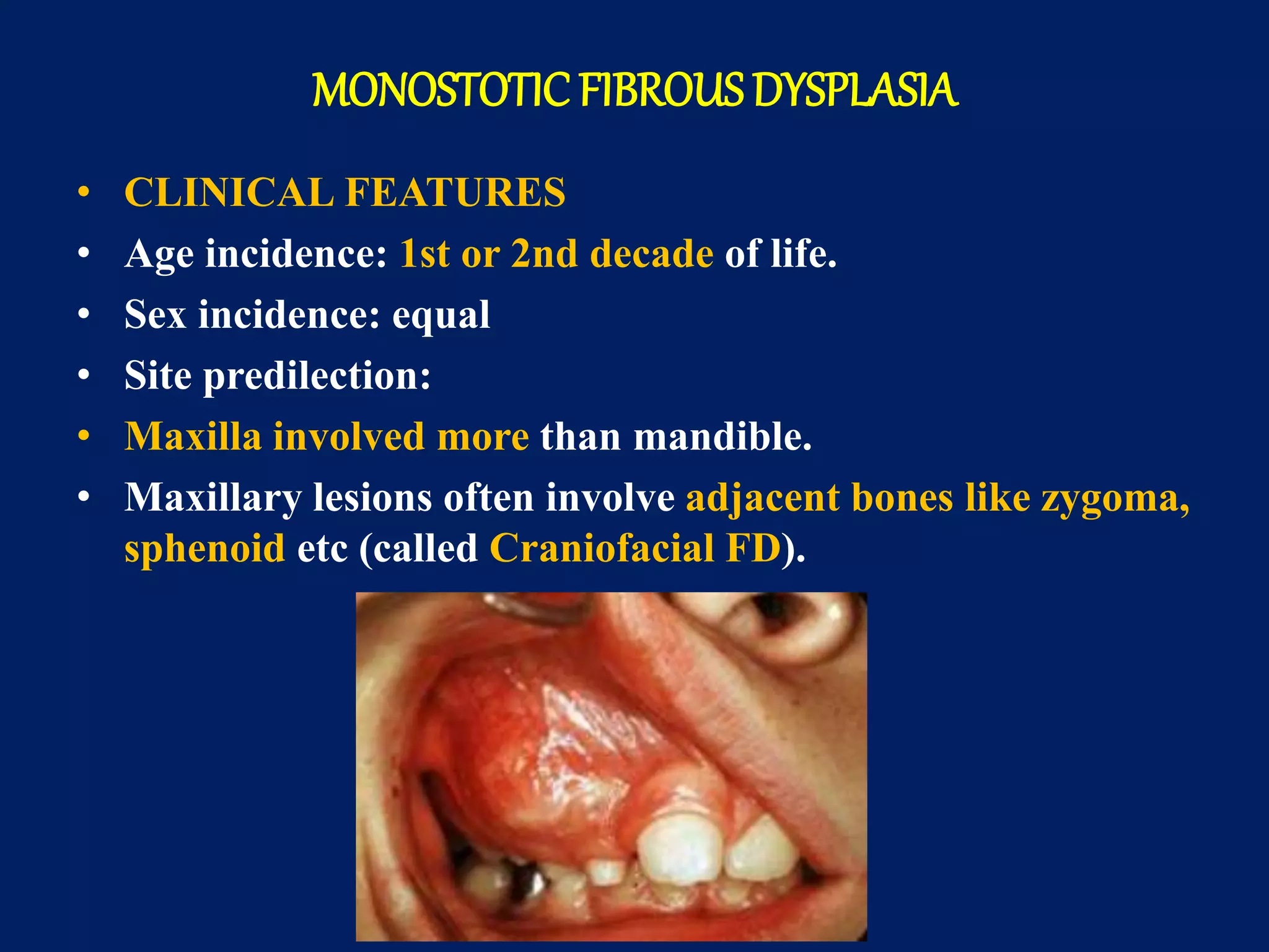 MONOSTOTIC FIBROUS DYSPLASIA
• CLINICAL FEATURES
• Age incidence: 1st or 2nd decade of life.
• Sex incidence: equal
• Site predilection:
• Maxilla involved more than mandible.
• Maxillary lesions often involve adjacent bones like zygoma,
sphenoid etc (called Craniofacial FD).
 