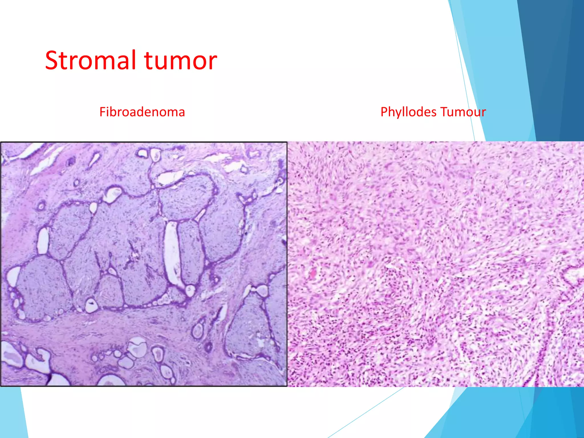 Stromal tumor
Fibroadenoma Phyllodes Tumour
 