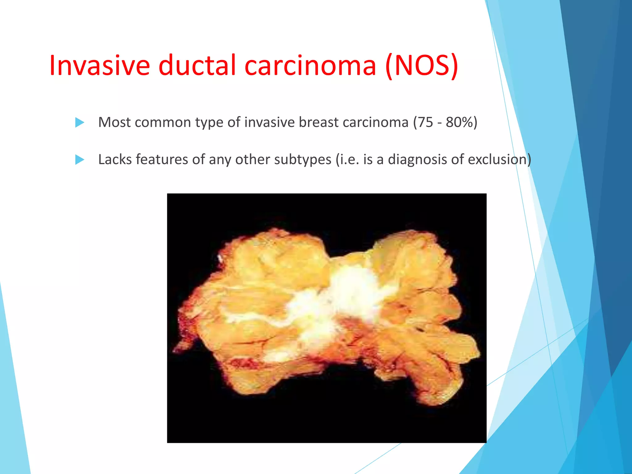 Invasive ductal carcinoma (NOS)
 Most common type of invasive breast carcinoma (75 - 80%)
 Lacks features of any other subtypes (i.e. is a diagnosis of exclusion)
 